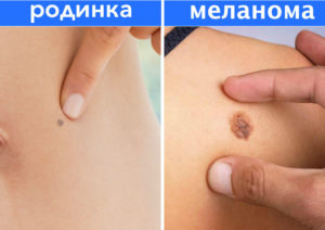 10 мифов о родинках, в которые пора перестать верить