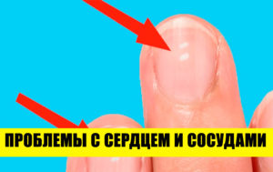 О чем говорят ваши ногти: 12 случаев, когда организм подает сигналы SOS