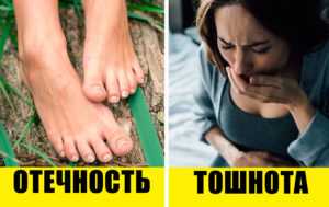 7 намеков на то, что у вас образовался тромб: как предотвратить трагедию?