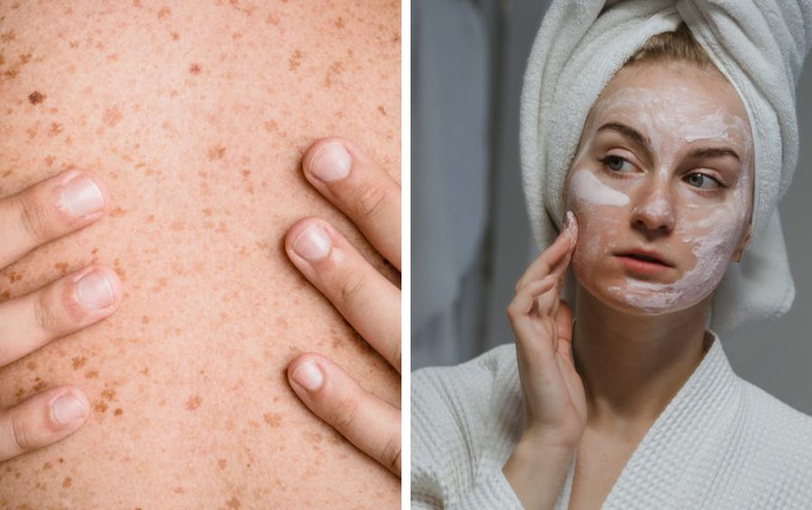 Почему появляется пигментация даже с SPF50: ошибки и советы