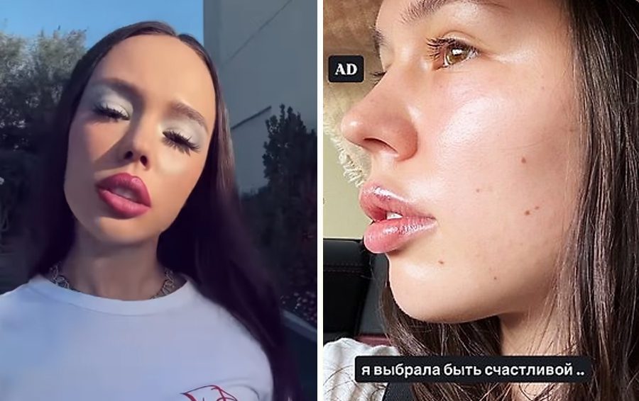 Фото: соцсети Инстасамка снова увеличенные губы после отказа от инъекций